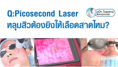Q:Picosecond Laser หลุมสิวต้องยิงให้เลือดสาดไหม?